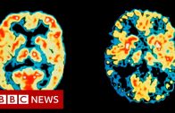 US approves first new Alzheimer’s drug in 20 years – BBC News