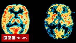 US-approves-first-new-Alzheimers-drug-in-20-years-BBC-News